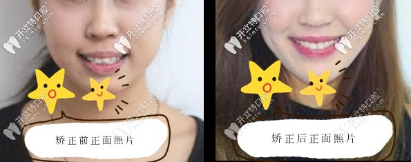 凸嘴戴隱適美牙套前后正面變化照片 凸嘴戴隱適美牙套前后正面變化照片