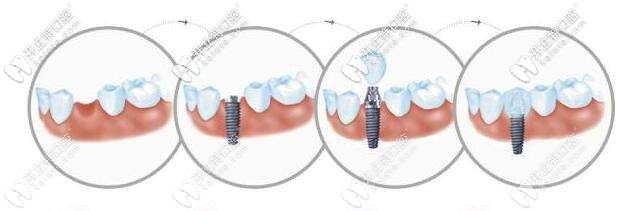 百康種植牙過程