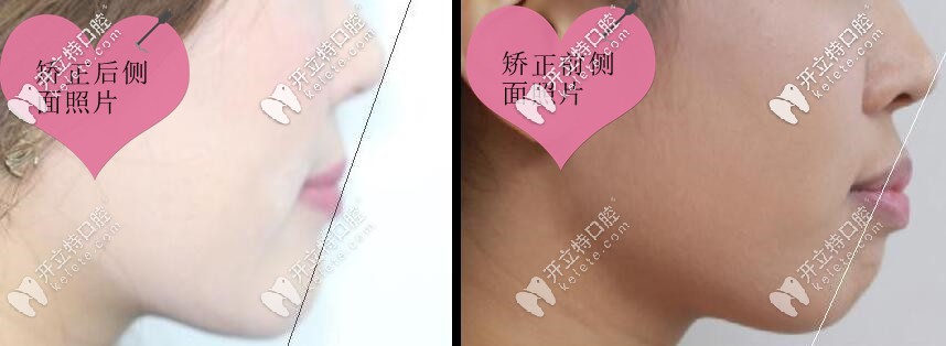 齙牙矯正前后側(cè)面對比照片 齙牙矯正前后側(cè)面對比照片