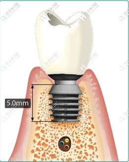 百康種植體的長度更短