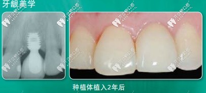百康種植體植入2年后外觀