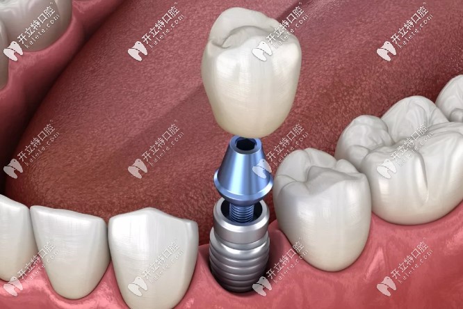 影響種植牙壽命的因素 影響種植牙壽命的因素