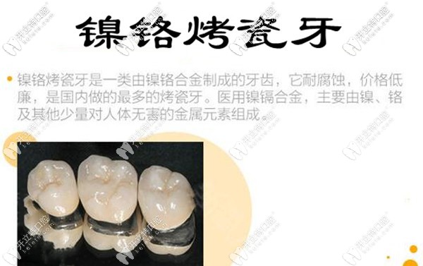 鎳鉻烤瓷牙價格