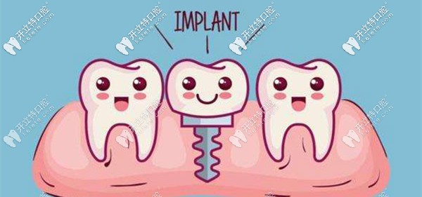 骨增量種植技術(shù)的講解