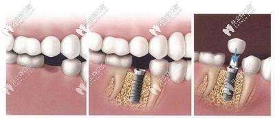 種植牙過(guò)程