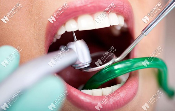 保護牙齒必須要做好口腔清潔衛(wèi)生，清除牙菌斑是關(guān)鍵