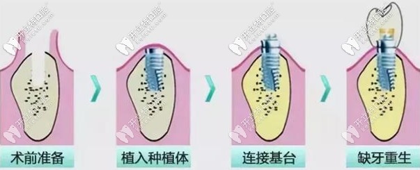 關(guān)于種植牙的一些誤區(qū)