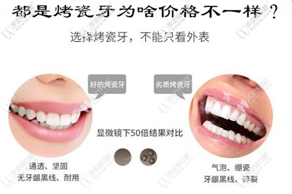 這份重慶烤瓷牙的種類及價(jià)格表,帶你避開鑲牙的套路