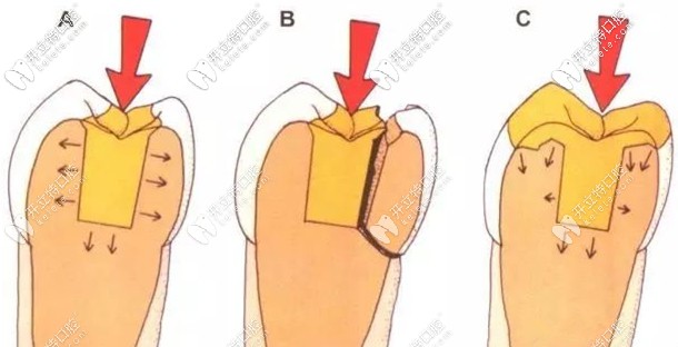 看完emax鑄瓷嵌體的特點(diǎn)，可算知道它的價(jià)格咋來的了