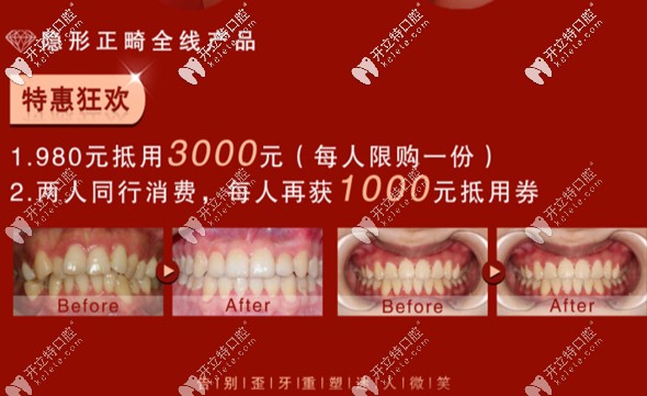 想在溫州做正畸?不妨了解下藝星開展的在家矯正牙齒的方法