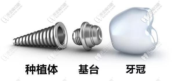 唯美口腔種植牙