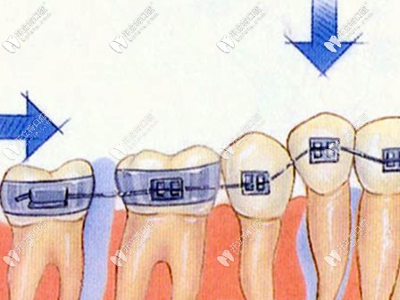 牙齒正畸的過程示意圖 牙齒正畸的過程示意圖