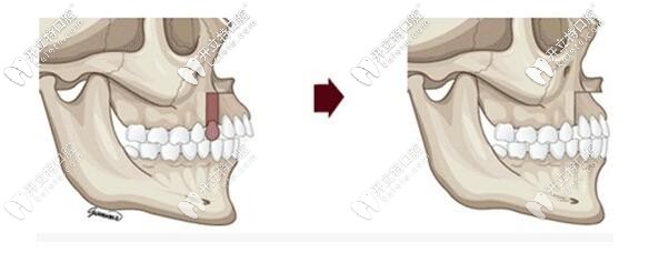 正頜的示意圖 正頜的示意圖