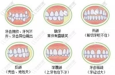 牙齒不齊的癥狀