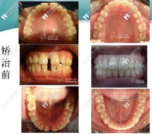 北京勁松口腔時(shí)代天使牙套案例