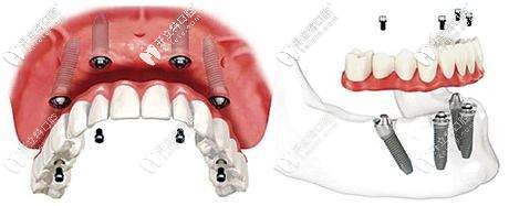 即刻負(fù)重種植牙