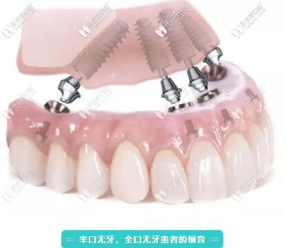 拔牙后能立即種牙嗎?北京做種植牙好的這家口腔說(shuō)出了真相