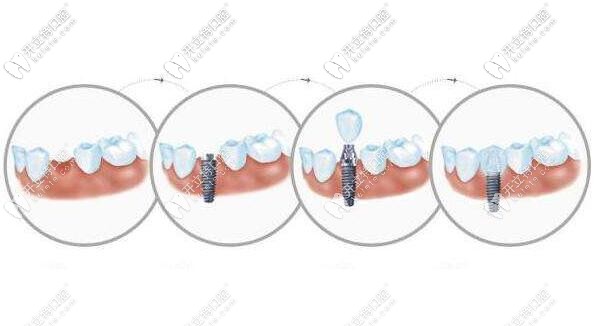 上海連鎖口腔復(fù)工了~韓國(guó)neo種植體包干價(jià)格很實(shí)在！