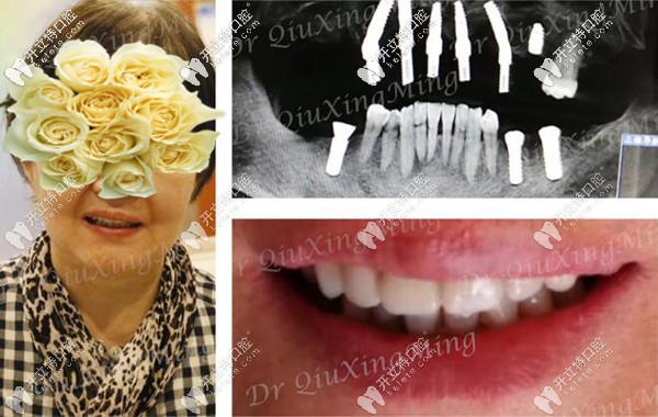 老媽做即拔即種即刻種植牙后的效果