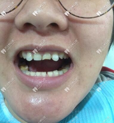 門牙磕斷了必須根管治療嗎?她還做了瓷貼面呢，超贊