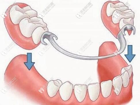 哇！在廣州戴過的掛鉤活動(dòng)假牙可以換購進(jìn)口種植牙啦！