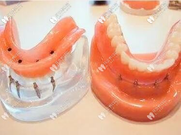 活動(dòng)假牙可以換購種植牙是真的