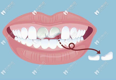 江湖救急!請問門牙斷了一半做補(bǔ)牙的價格是多少啊