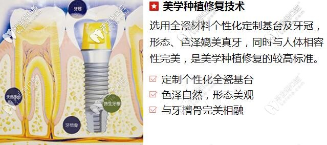 貴陽(yáng)柏德口腔美學(xué)種植修復(fù)技術(shù)