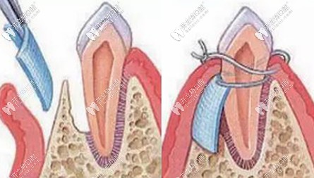 GBR膜引導骨組織再生術
