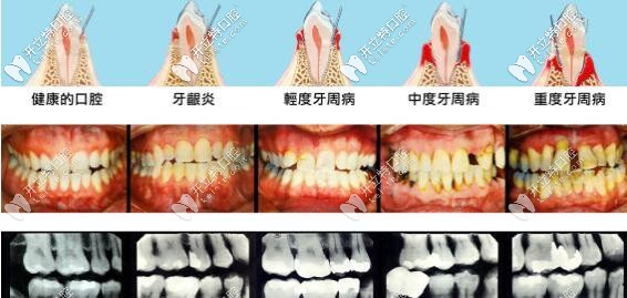 牙周炎發(fā)展過程