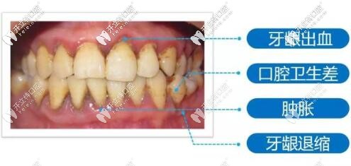 牙周炎的表現(xiàn)
