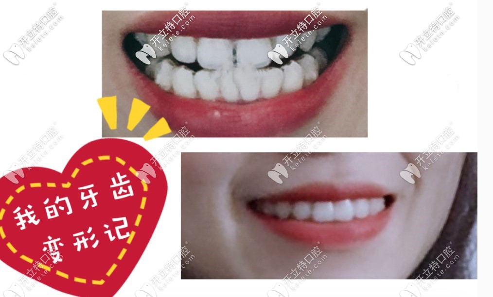 戴時代天使矯正牙齒稀疏后的效果圖