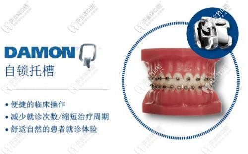 美國DamonQ金屬自鎖托槽