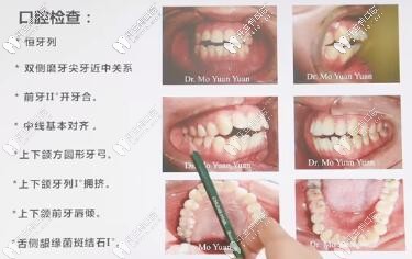 骨性前凸開頜,拔牙四顆,進口ormco自鎖托槽矯正,歷時22個月