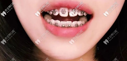 帶上牙套后的樣子