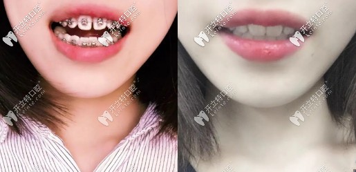 整牙前后對比照有種知性美