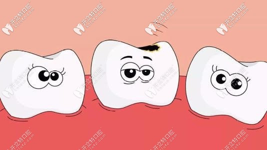 齲齒的卡通形象示意圖