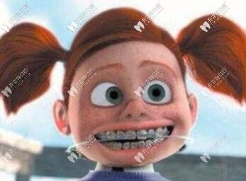 被價(jià)格勸退,中意時(shí)代天使,卻選擇了博思美隱形矯正+片切