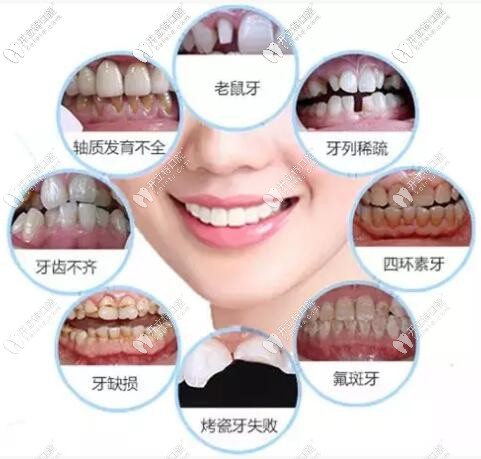 經(jīng)歷2次修復,說說做完瓷貼面的真實感受,有后悔,也有驚喜