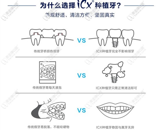 為什么會選擇做ICX種植系統(tǒng)