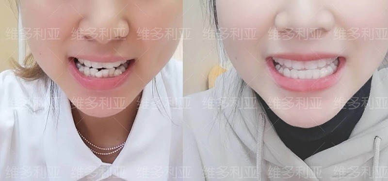 門牙外翻在杭州做隱適美隱形矯正已10個(gè)月,效果肉眼看可見