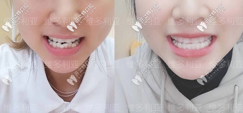 門牙外翻隱形矯正10個月前后對比