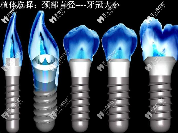 種植體頸部直徑