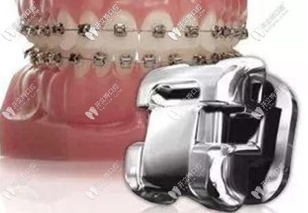 自鎖托槽矯正器圖片 自鎖托槽矯正器圖片