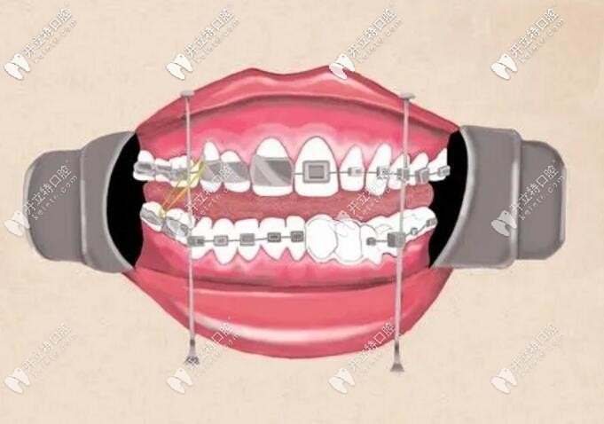 正畸牙套 正畸牙套