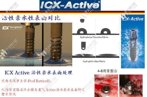 ICX種植體的表面處理技術(shù)
