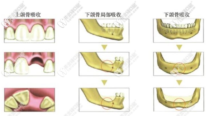 瑞鋯親水種植體可以避免植骨手術(shù)