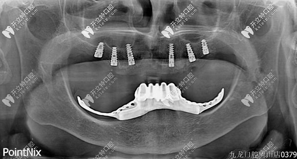 看好了:這是用美國(guó)百康種植體做的all-on-6半口種植牙案例哈