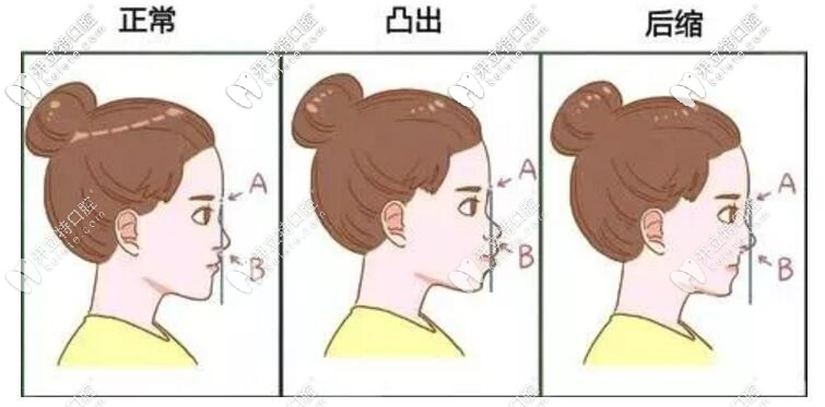 牙齒畸形影響臉型 牙齒畸形影響臉型