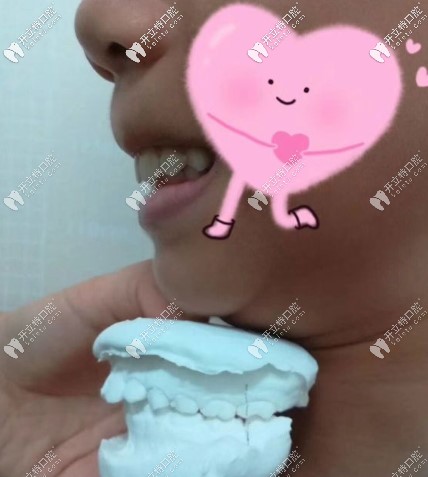 8歲女兒齙牙在常德武陵區(qū)口腔醫(yī)院戴羅慕誘導(dǎo)矯正器1年了
